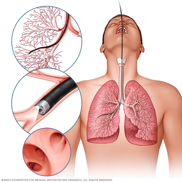 Bronchoscopy procedure illustration showing scope inserted into lungs for diagnosis and treatment