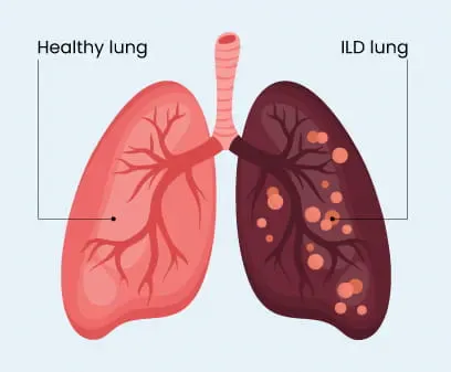 Interstitial lung disease illustration comparing healthy lung and ILD affected lung