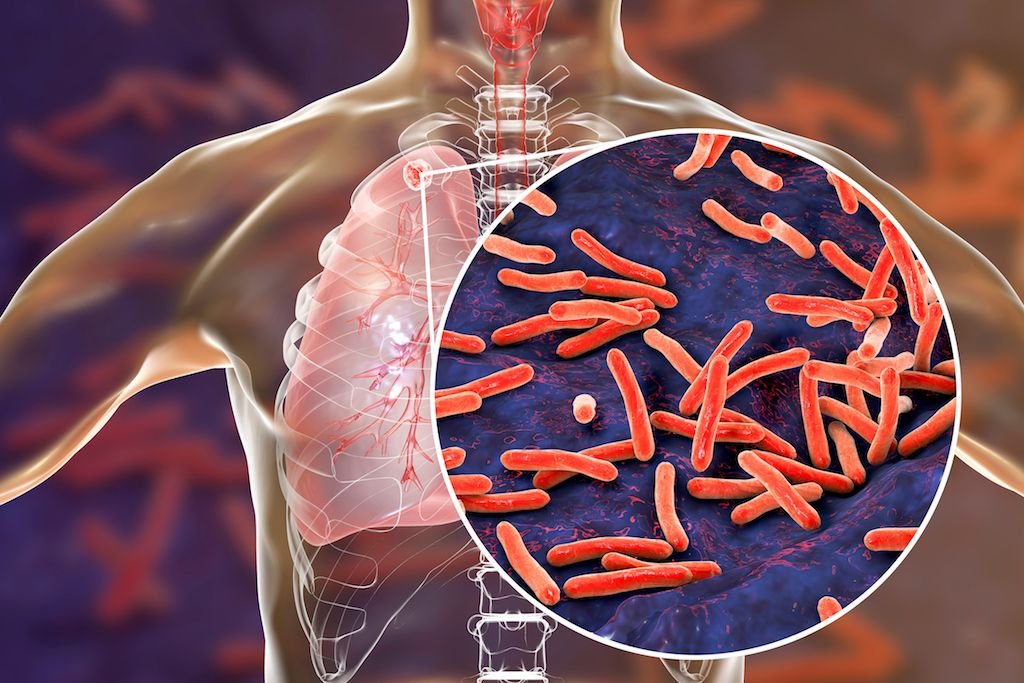 Tuberculosis TB bacteria affecting lungs causing lung infection and breathing problems