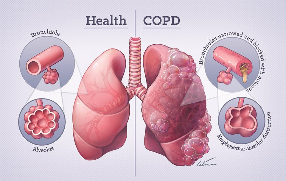 Comparison illustration of healthy lungs and COPD affected lungs showing airway narrowing and alveolar damage