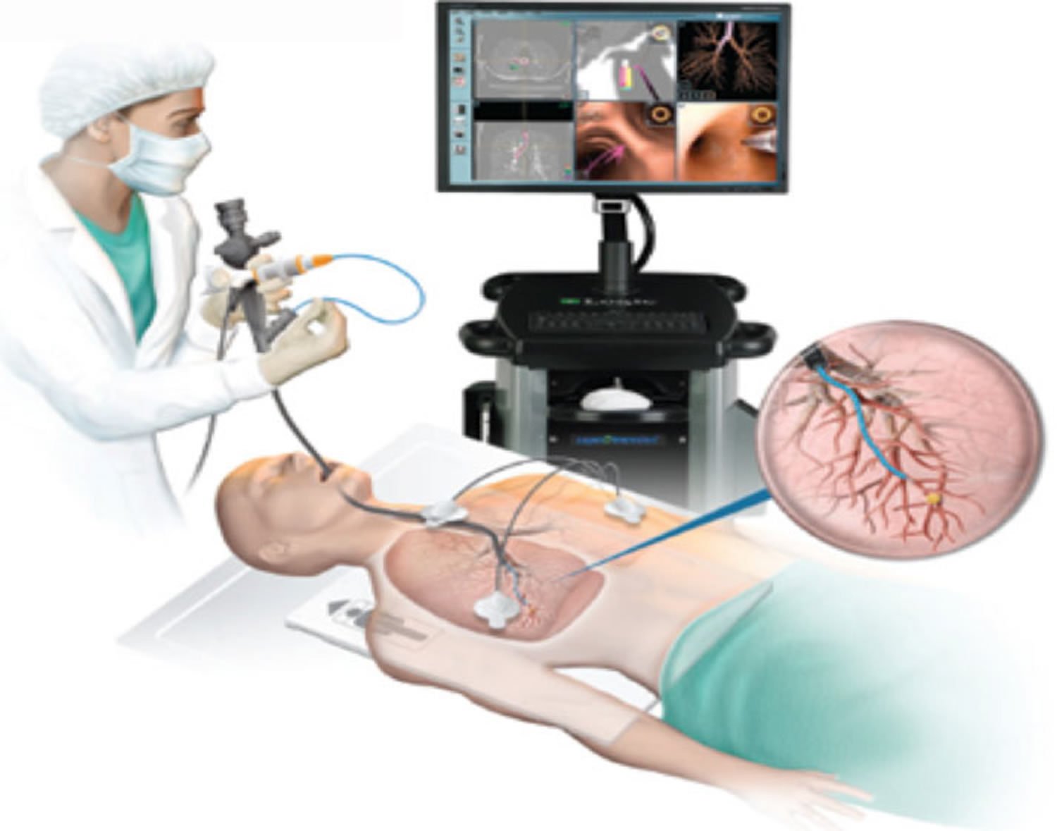 Bronchoscopy procedure illustration showing doctor examining lungs using bronchoscope for airway diagnosis