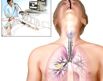 Bronchoscopy procedure illustration showing bronchoscope entering lungs through airway