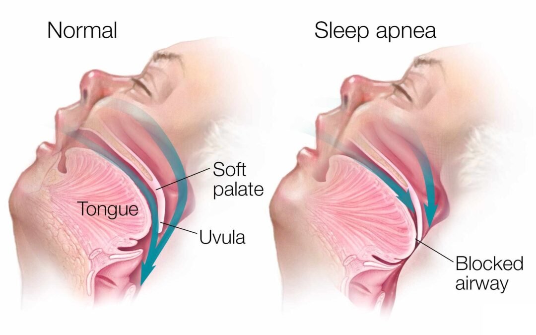 Illustration showing normal airway vs blocked airway in sleep apnea condition