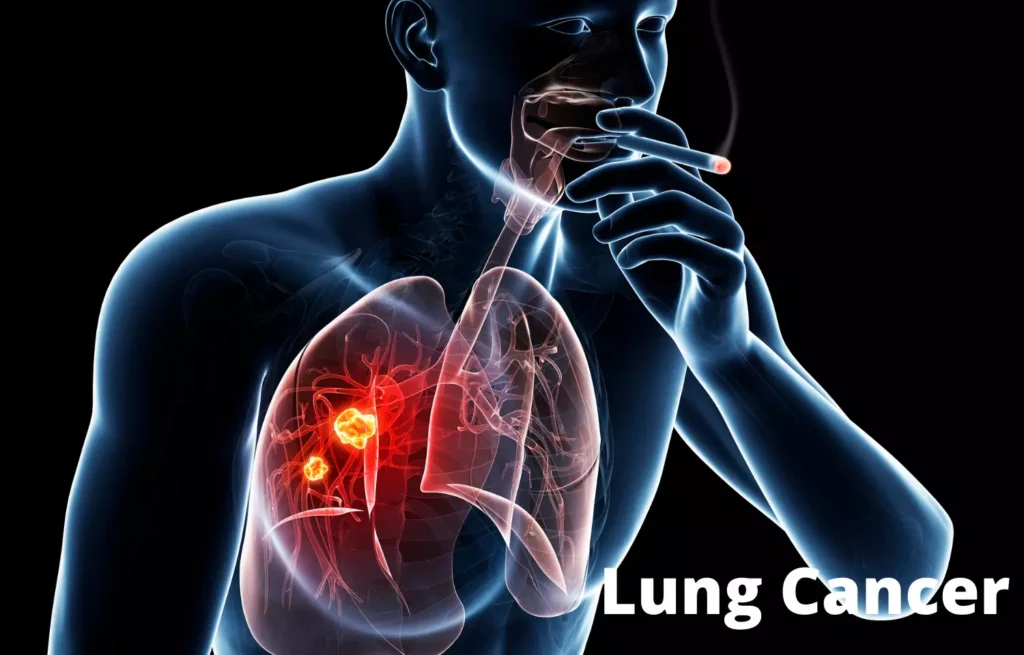 Smoking causing lung cancer with tumor growth visible inside human lungs illustration